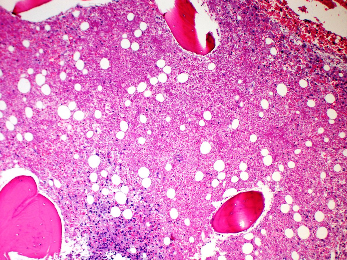 Core biopsy section showing extensive necrosis (H&E, 100x)